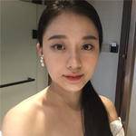 敏敏玻尿酸豐面頰術后210天 圖3