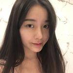 敏敏玻尿酸豐面頰術后3天 圖4