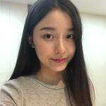 敏敏玻尿酸豐面頰術后14天 圖5
