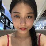 敏敏玻尿酸豐面頰術后45天 圖2