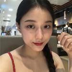 敏敏玻尿酸豐面頰術后45天 圖3