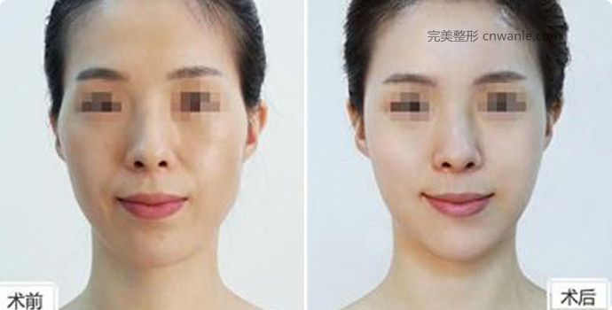 <a href='/tag_boniaosuanfengmian2.html'>玻尿酸豐面頰</a>