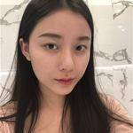 敏敏玻尿酸豐面頰術后3天 圖2