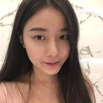 敏敏玻尿酸豐面頰術后3天 圖5