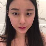 敏敏玻尿酸豐面頰術后7天 圖1