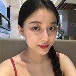 敏敏玻尿酸豐面頰術后45天 圖5