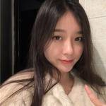 敏敏玻尿酸豐面頰術后138天 圖5