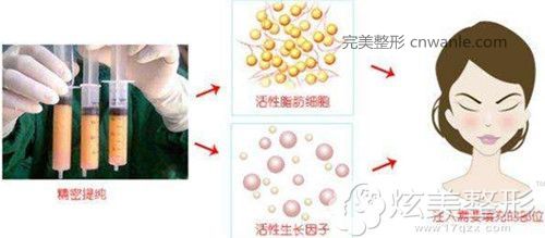 注射<a href='/tag_zitizhifangfeng.html'>自體脂肪豐臉</a>頰