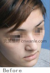 玻尿酸豐面頰<a href='/tag_qianhouduibi.html'>前后對(duì)比</a>照片
