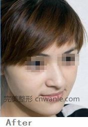 玻尿酸豐面頰前后對(duì)比照片