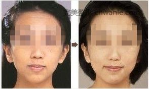 <a href='/tag_boniaosuan41.html'>玻尿酸</a>豐<a href='/tag_lianjia5.html'>臉頰</a>效果