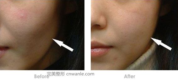 玻尿酸豐臉頰的效果怎么樣