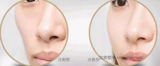 玻尿酸注射豐面頰術(shù)好不好?玻尿酸注射豐面頰用過多久見效果?