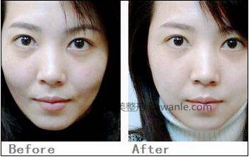 <a href='/tag_boniaosuanzhushe37.html'>玻尿酸注射</a>豐面頰