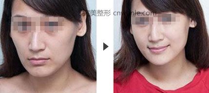 吉林市銘醫(yī)<a href='/tag_zhengxingmeirong8.html'>整形美容</a>醫(yī)院豐面頰
