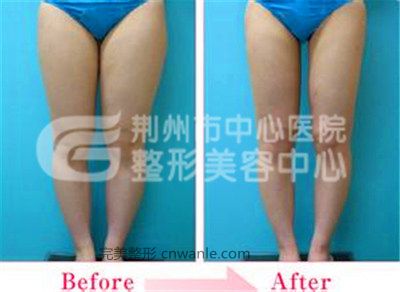 <a href='/tag_datuixizhishu.html'>大腿吸脂術(shù)</a>會不會反彈呢?