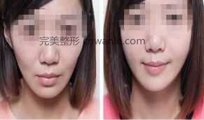 玻尿酸<a href='/tag_fengmianjia.html'>豐面頰</a>效果自然嗎