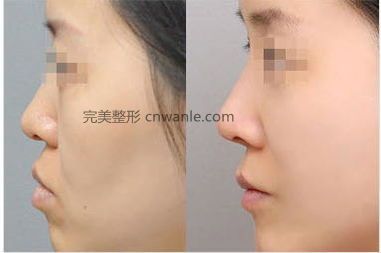 玻尿酸豐面頰怎么樣