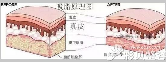 吸脂原理圖