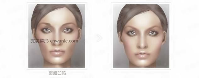 臉部<a href='/tag_daboniaosuan4.html'>打玻尿酸</a>豐臉頰效果好嗎