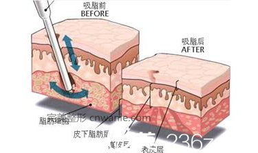吸脂手術原理
