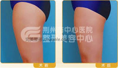 做過(guò)大腿吸脂手術(shù)后會(huì)不會(huì)反彈?