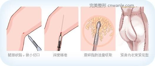 <a href='/tag_datuixizhishou.html'>大腿吸脂手術(shù)</a>