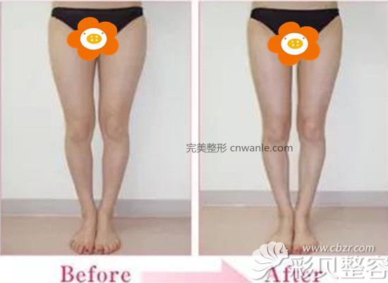 大腿吸脂前后對比圖