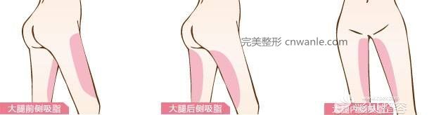 大腿吸脂術(shù)部位展示