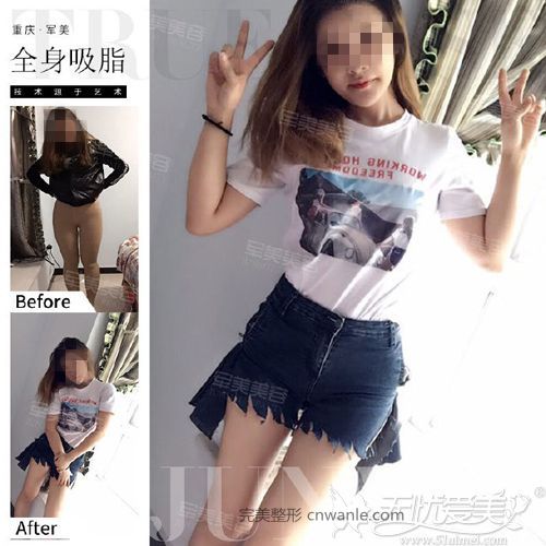 大腿吸脂前后對比效果