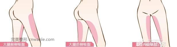 大腿吸脂術部位展示