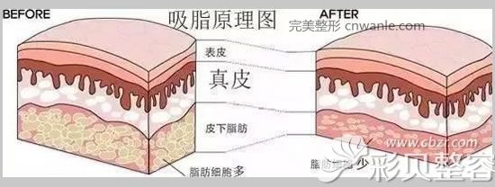 吸脂原理圖