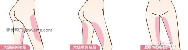 大腿吸脂術(shù)部位展示