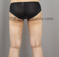 什么是<a href='/tag_datui21.html'>大腿</a><a href='/tag_xizhijianfei25.html'>吸脂減肥</a>手術(shù)?