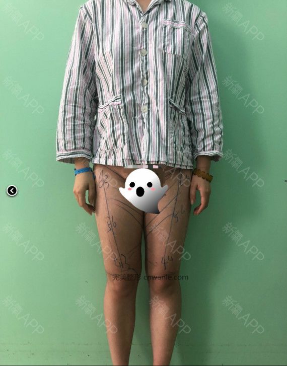 吸脂