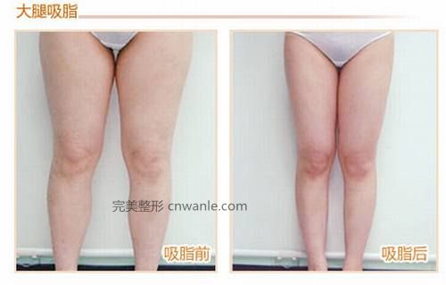 <a href='/tag_datuixizhi10.html'>大腿吸脂</a><a href='/tag_qianhouduibi.html'>前后對(duì)比</a>照