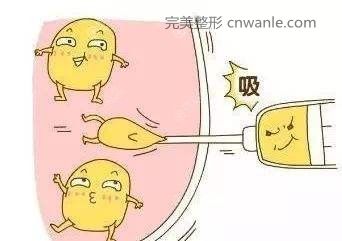 大腿吸脂會(huì)不會(huì)反彈？