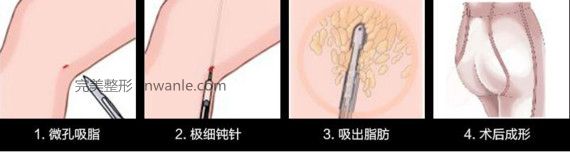 吸脂