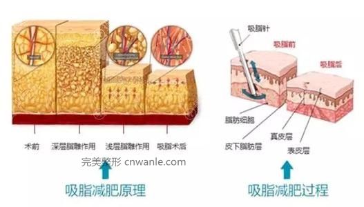吸脂減肥原理