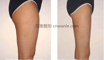 腿部吸脂<a href='/tag_qianhouduibi.html'>前后對比</a>圖