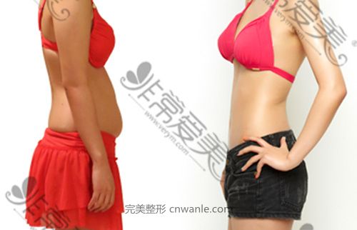 韓國(guó)Lyhn診療&整形外科腰腹吸脂案例對(duì)比圖