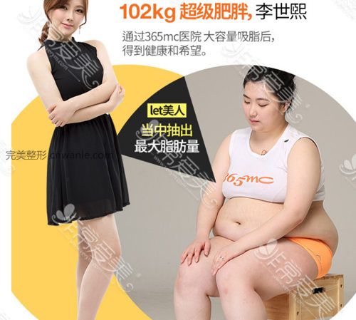 let美人節(jié)目吸脂案例
