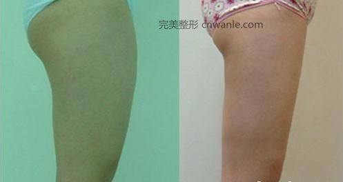 做了<a href='/tag_datuixizhishou.html'>大腿吸脂手術(shù)</a>后會(huì)反彈嗎？