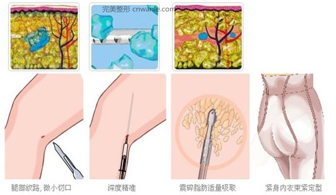 大腿吸脂術(shù)