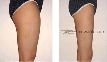 腿部吸脂<a href='/tag_qianhouduibi.html'>前后對比</a>圖