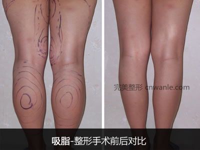 腿部<a href='/tag_xizhihuifandan.html'>吸脂會反彈嗎</a>?