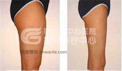 大腿做<a href='/tag_xizhijianfei25.html'>吸脂減肥</a>會(huì)反彈么？