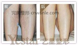 成都藝星激光脫腿毛會痛嗎