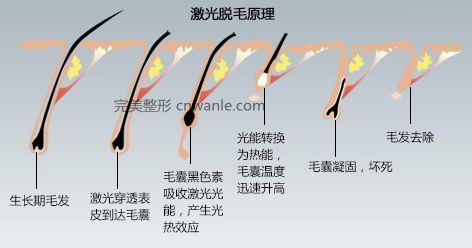 冰點(diǎn)無(wú)痛 脫毛儀脫毛原理