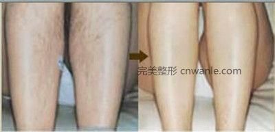 冰點(diǎn)脫毛幾個月會長出來